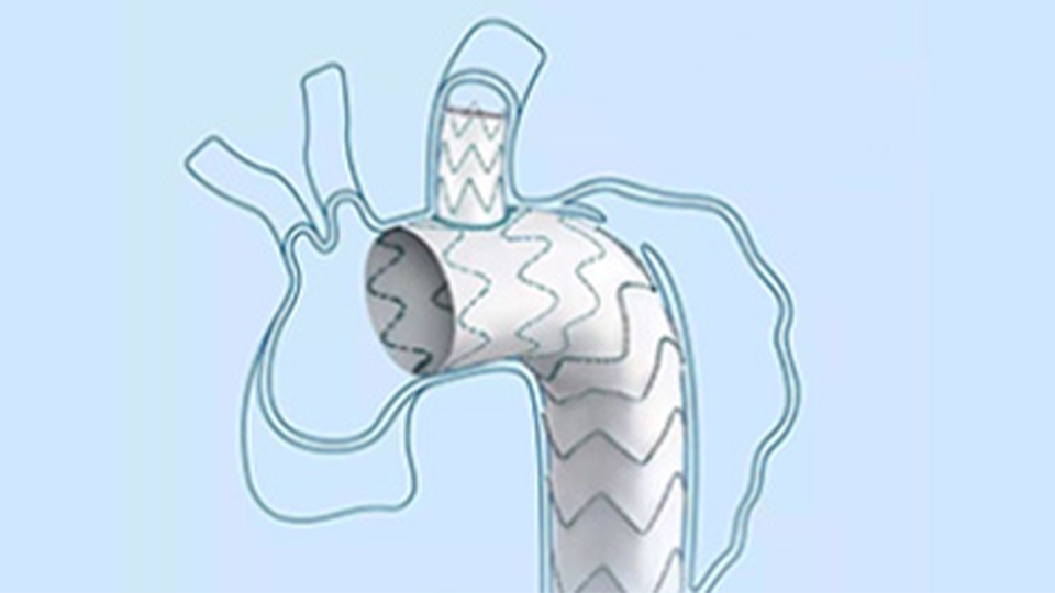 Multi-branch Artificial Blood Vessel Stent Graft System