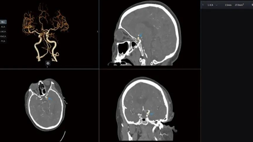 Intracranial Aneurysm Impact Ancillary  Diagnostic Software