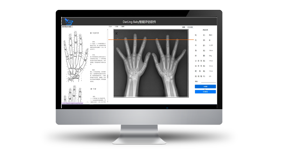 Intelligent Auxiliary Diagnostic Software for Pediatric Bone Age Assessment