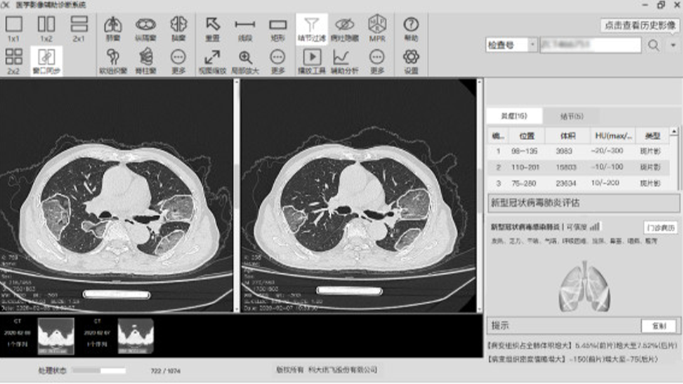 Pneumonia Assisted Diagnosis Software