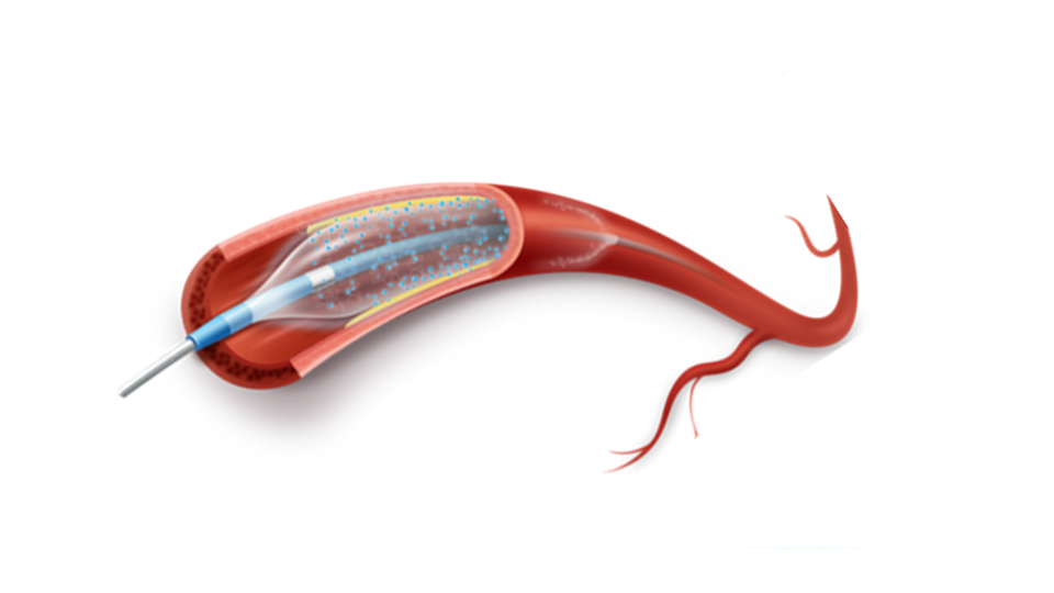 Intracranial Drug Coated Balloons